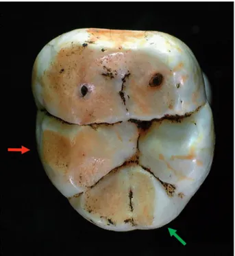 Figure 7. Occlusal and buccal tooth wear on the left 1 st  lower molar  (FDI 36). Non dietary wear is also visible on the buccal aspect of  cusps 1 and 3