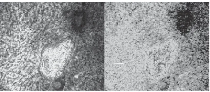 Figure 7. Cervical intra-epithelial neoplastic cells 3 (INC3). Left: 