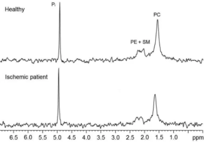 Figure 1. Representative  31 P{ 1 H} NMR spectra of serum samples from a  healthy individual and a ischemic stroke patient with signals assignment  according to Kuliszkiewicz-Janus and Baczyński, 13  as phosphatidylcholine  (PC), phosphoethanolamine (PE), 