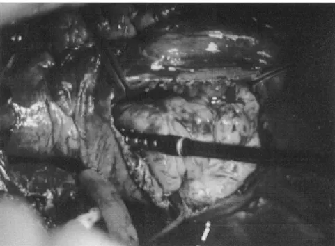 Figure 1 - Leiomyosarcoma of the IVC in the right atrium.