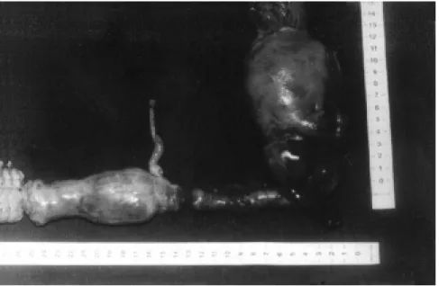 Figure 3 - Intravenous Leiomyomatosis of the uterus after resection.