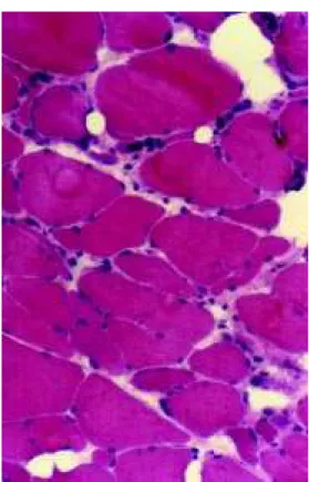 Fig. 2 - Muscle biopsy. We found accentuated variation of muscle fiber size with the presence of ragged, rounded degenerating fibers.