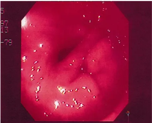 Figure 1: Endoscopic view of a double pylorus. The bridge between the two channels is easily visualized