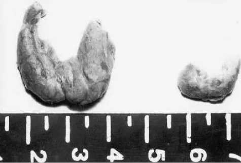 Figure 2 - Thyroid of the stillborn fetus described in the present report. Note the diffuse enlargement on the left compared to the thyroid of another stillborn fetus of the same gestational age (36 weeks).
