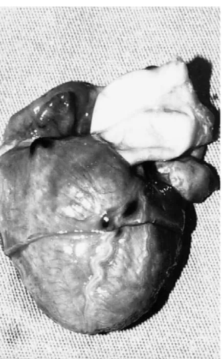 Figure 4 - Globally enlarged heart due to inten- inten-se dilatation of the cavities.