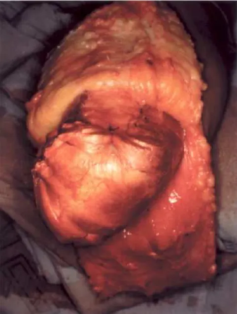 Figure 3 – Myoplasty.