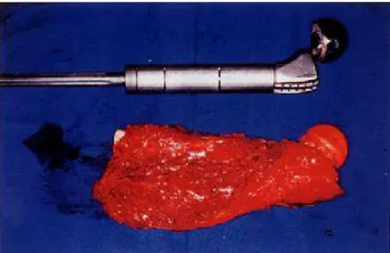 Figure 15 - Resected distal femur osteosarcoma and the articulated total knee endoprosthesis.