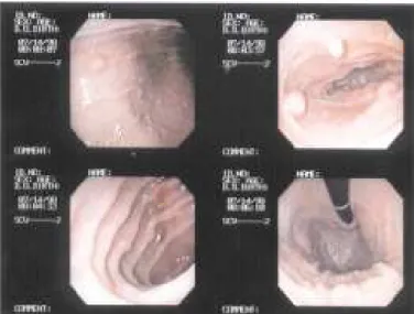 Figure 6 - Enteroscopy performed during laparotomy detected the polipys in small intestine.