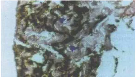 Figure 3 -  Histological section of the interfoveolar ligament from aged men showed shortened fragmented, and thickened elastic fibers