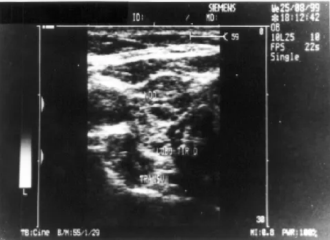 Figure 1 -  Thyroid ultrasonography revealed a diffuse heterogeneous aspect, suggestive of chronic thyroiditis, and a nodule, 0.8 x 0.7cm, in the same fascial plane of the gland and without contact with the upper limit of the right lobe.