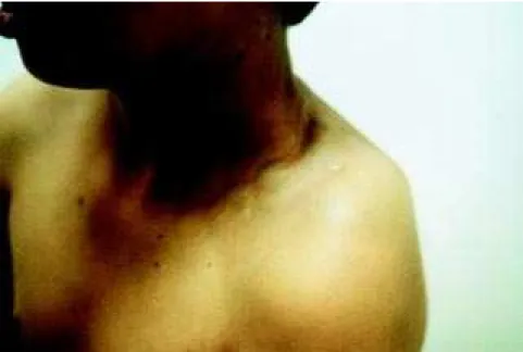 Figure 1 - Cistic lesions on the left supraclavicular area.