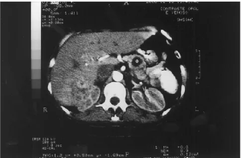 Fig. 3 - Pancreatic mass and metastatic nodules in the liver in computed tomography scan.