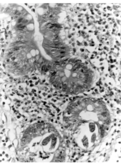 Figure 1 - Enteritis by Strongyloides stercoralis.