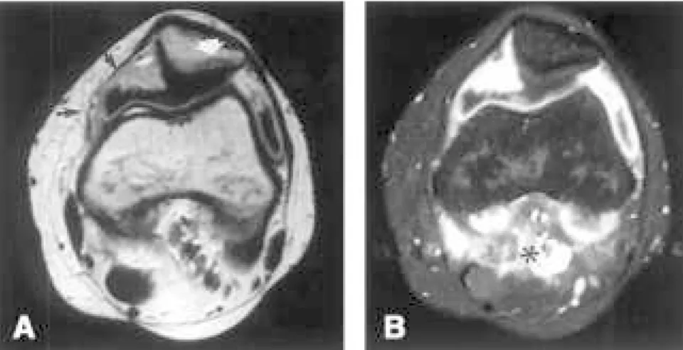 Table 5 outlines relationships be- be-tween types of osteochondral  abnor-malities and MRI findings