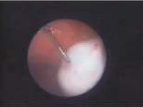 Figure 1 - Ovarian endometriosis approached by microlaparoscopy.