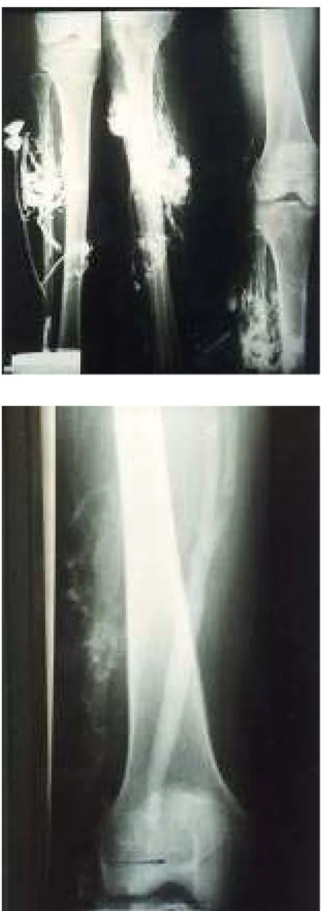 Fig. 4 - Surgical removal of the lateral marginal vein through small excisions in the skin with suture of perforating veins.