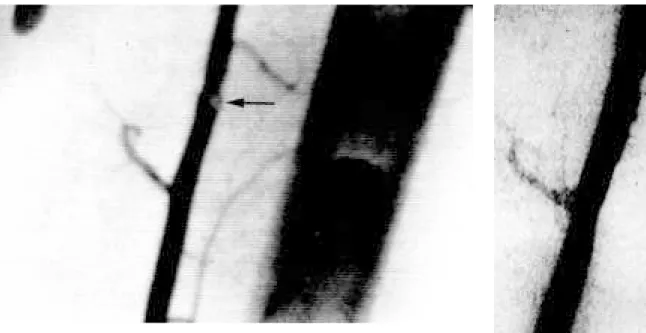 Figure 2 - Arteriography after stenting the intimal flap.