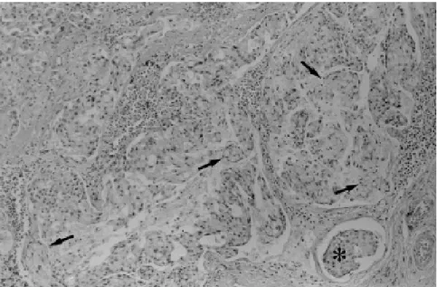 Figure 1 -  Mucin containing signet-ring cells of invasive gastric adenocarcinoma (arrows), and neoplastic embolus (*) in gastric vessels (hematoxylin-eosin X 125).