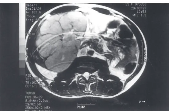 Figure 1 - Nuclear magnetic resonance shows a large, low-density solid mass in the right hepatic lobe of the liver.
