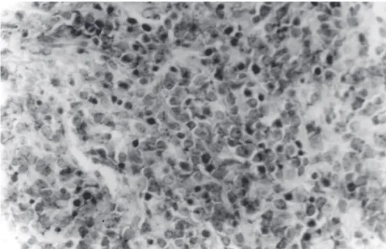 Figure 3 - Microscopic findings show a uniform population of lymphoid cells of large size with many mitotic figures (H&amp;E, original magnification x480).