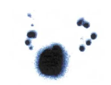 Figure 1 - Normal and symmetrical progression.