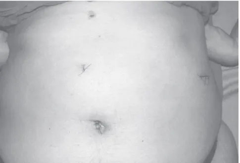Figure 1 - Trocar placement for laparoscopic splenectomy: (1) a 10-mm camera port at the umbilicus; (2) a 5-mm working port half way between the umbilicus and the xiphoid process in the midline; (3) a 5-mm hepatic retractor port at the xiphoid process; (4)