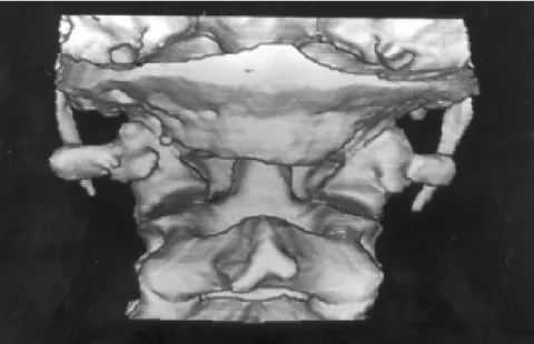 Figure 3 - Three-dimensional rendering of the craniovertebral region, posterior view. The abnormality of C1 and the craniovertebral region are viewed to best advantage