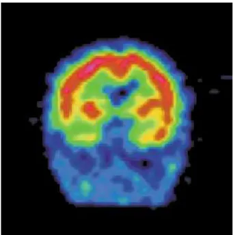 Figure 1 - Nuclear Magnetic Resonance – frontal hemorrhage at the left frontal lobe as well as multiple subacute and chronic lesions widespread through the white matter.