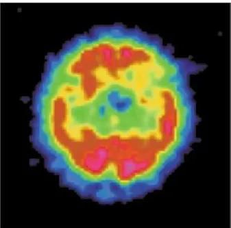 Figure 3 - SPECT scan – transversal section – left frontal hypoperfusion.