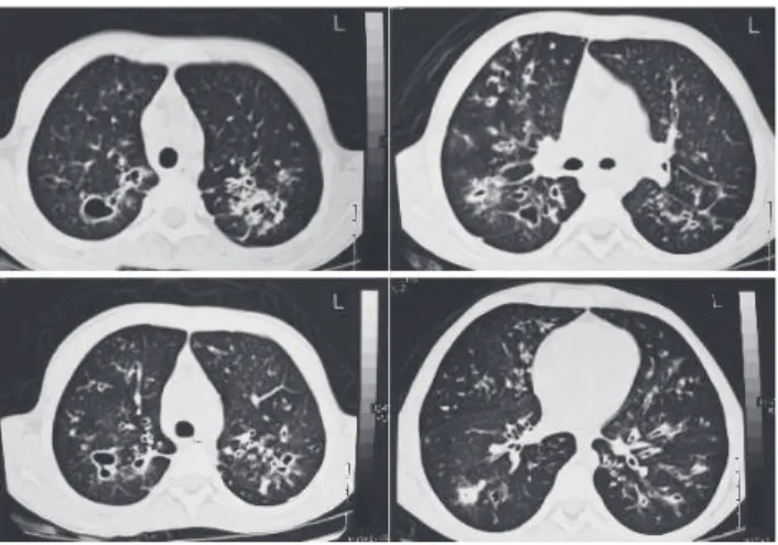 Figure 1 - High resolution computer tomography scans showing diffuse bronchiectasis and large cysts in upper lobes.