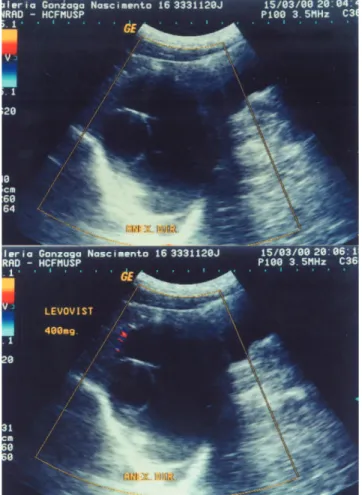 Table 1 - Histologic diagnosis and results of blood flow distribution in 62 ovarian tumors without use of contrast.