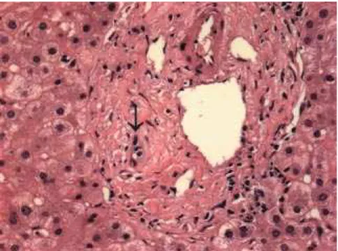 Figure 2 - Liver biopsy showing degenerative alterations in the interlobular bile ducts (arrow).