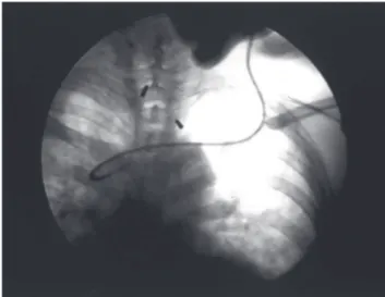 Figure 4 - Patient 2- Correct catheter tip positioning using endovascular techniques (guide wire and catheter with a preformed curve).