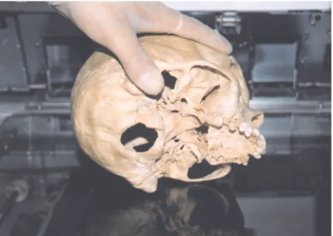 Figure 1 - The standardized technique for obtaining a xerographic copy of the skull.