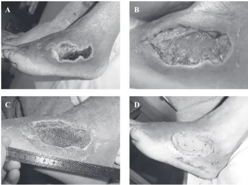 Figure 2 - Case 1 - A: Infection of diabetic foot; B: Wound after skin debridement of necrotic tissue;  C: Seventh day of vacuum therapy; D: Aspect one week after skin graft.