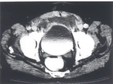 Figure 1 - Patient on the 15th POD. Abdominal pelvic CT scan showed an abscess in the preperitoneal space (arrow).