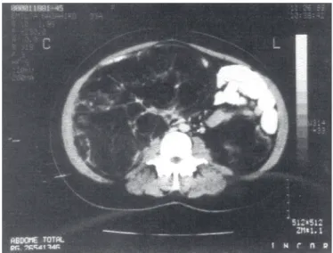Figure 1 - Computed tomography before surgery: A giant angiomyolipoma (23 x 21 x 11.5 cm) in the right kidney and another (13 x 9.5 x 5.5 cm) in the left kidney.