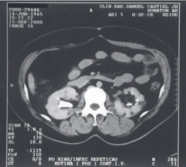 Figure 2 - Computed tomography 2 years after surgery: Only small intra-parenchymatous angiomyolipomas less than 1 cm are present in both kidneys, and good kidney preservation is apparent.