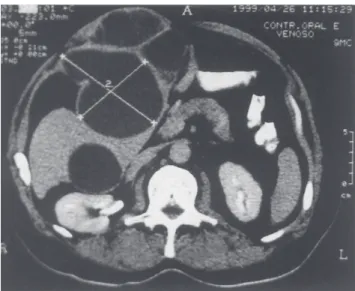 Figure 1 - Falciform ligament abscess as a cylindrical mass in the anterior abdomen at computed tomography.
