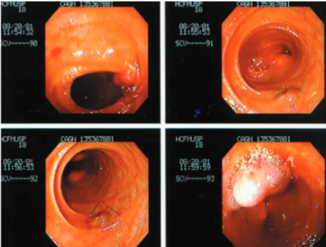 Figure 2 - Endoscopic view. Notice the purse string suture in the lower left slide.