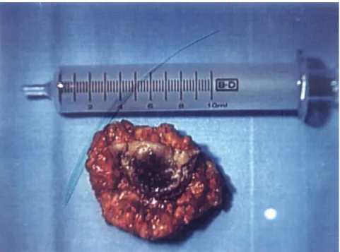Figure 2 – Abdominal CT scan with IV contrast (cystic lesion with solid components in the pancreatic body).