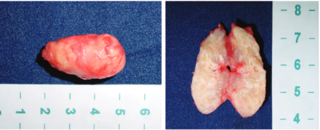 Figure 5 - Dissection, transanal excision of the tumor and mucosal closure (case 2).