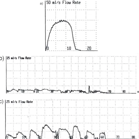 Figure 1 - Uroflowmetry. (a) Normal uroflow (Q max  = 30 mL/s) in a 67-year-old man presenting with filling symptoms 6 months after a transurethral resection of the prostate
