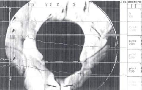 Figure 4 -Videourodynamics. A 64-year-old woman complaining of hesitancy, low flow, and frequency 2 years after a transvaginal anti-incontinence surgery and 1 year after a cerebrovascular accident
