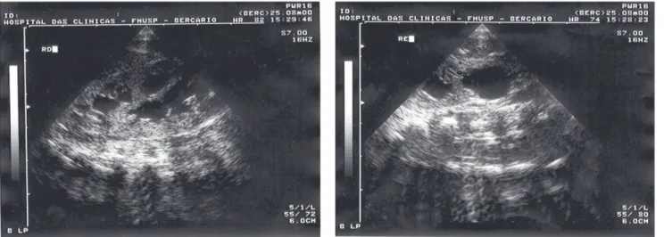 Figure 1 - Newborn infant with coarse face, midfacial retraction, and generalized hypertrichosis.
