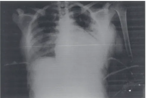 Figure 2 - Thoracic radiograph showing diffuse alveolar condensations and increase of cardiac area.