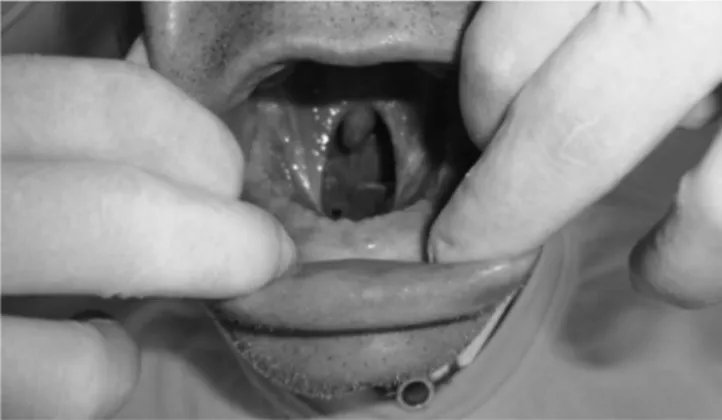 Figure 1. Total glossectomy with removal of the floor of the mouth