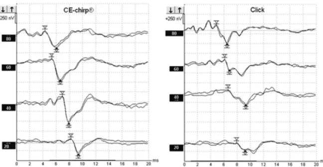 Figure 3. Example of BAEP recording with click and CE-chirp ®  stimuli in one of the subjects in the study
