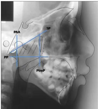 Fig. 1. Planes that define the trapezoid for calculation of the  nasopharyngeal area: palate plane (PP), sphenoid plane (SP),  plane going through AA (PAA) and pterygomaxillary plane (PtmP).