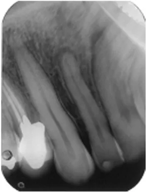 Fig. 1. Baseline radiograph.